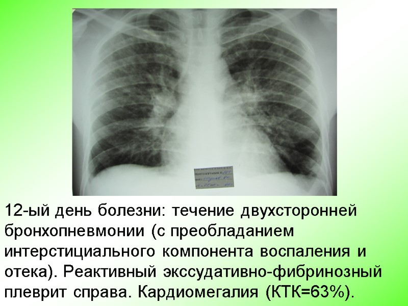 12-ый день болезни: течение двухсторонней бронхопневмонии (с преобладанием интерстициального компонента воспаления и отека). Реактивный